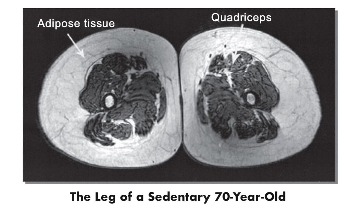 MRI scan of a 70-year-old man in poor cardiorespiratory shape.